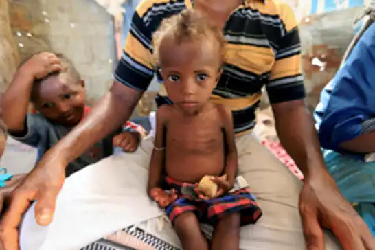 DSÖ'den Yemen'de kızamık ve çocuk felci uyarısı