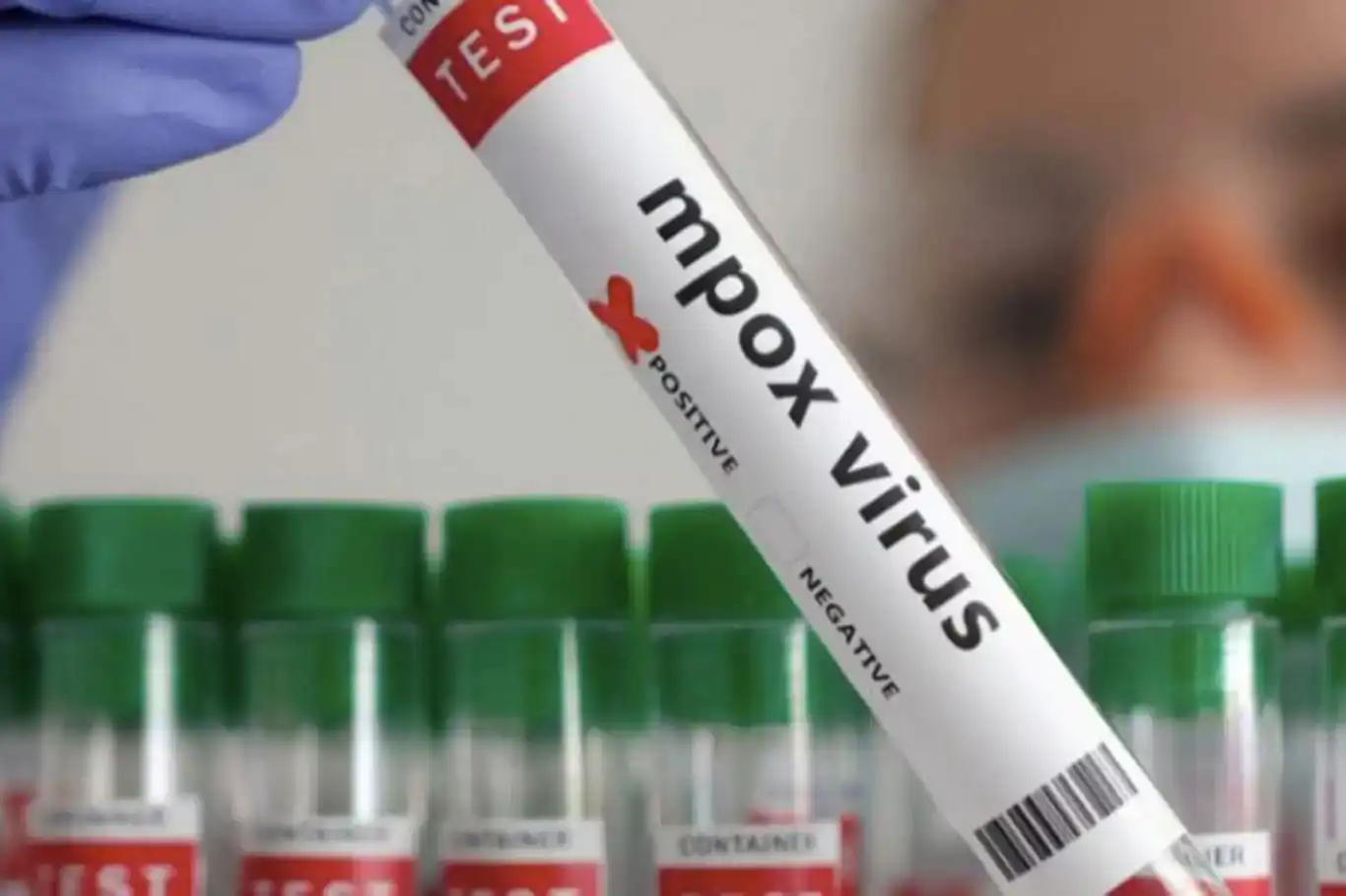 Namibia confirms first MPOX case in coastal city of Swakopmund Namibia confirms first MPOX case in coastal city of Swakopmund