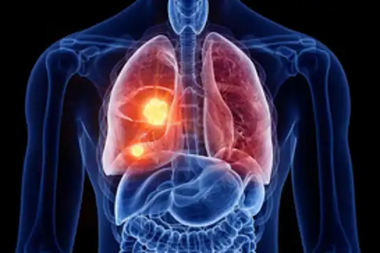 Akciğer kanseri riskini artıran faktörler