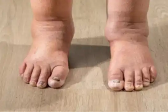 Kollarınızda veya bacaklarınızda şişlik varsa nedeni lenfödem olabilir!