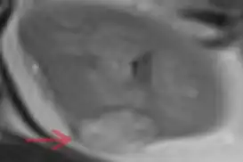 Laparoskopik Parsiyel Nefrektomi ile Ağrı'da bir ilk gerçekleştirildi!