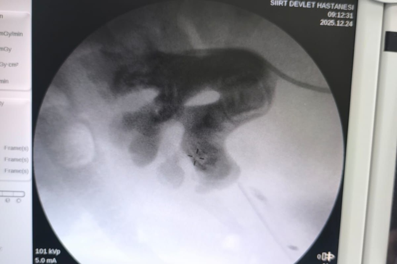 Siirt'te "Staghorn" böbrek taşı tek seansta temizlendi