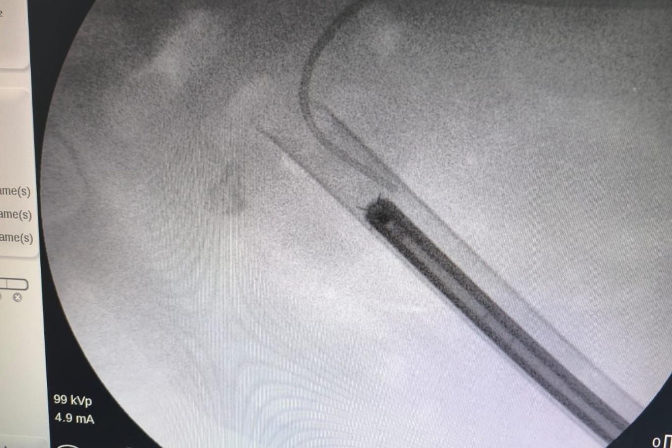 Siirt'te "Staghorn" böbrek taşı tek seansta temizlendi