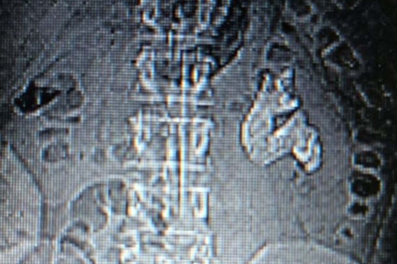 Siirt'te "Staghorn" böbrek taşı tek seansta temizlendi