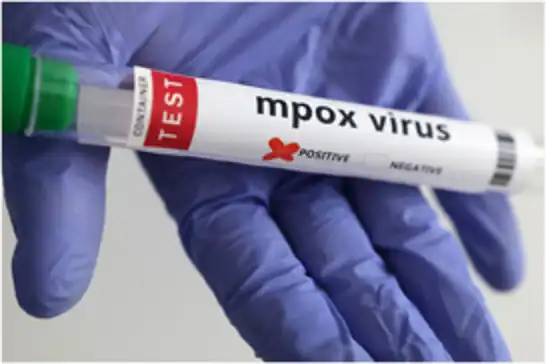 İngiltere’de mpox virüsünün yeni bir türü tespit edildi