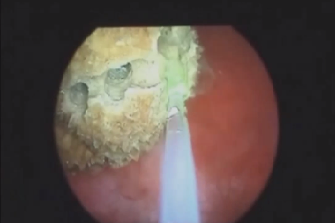 Böbrek taşı çocuklarda neden oluşur? Böbrek taşı çocuklarda neden oluşur?