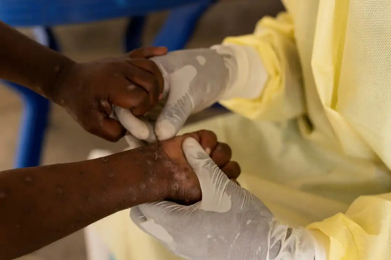 Gana'da 4 kişide M çiçeği vakası tespit edildi