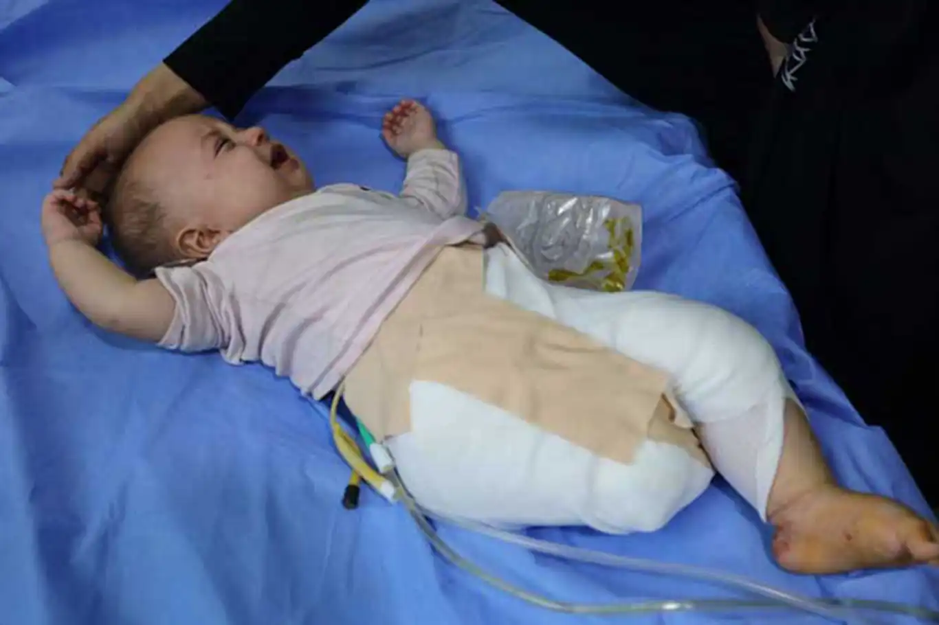 Minik Hani'nin ayağı siyonist bombalarla koparıldı, gülüşü de susturuldu Minik Hani'nin ayağı siyonist bombalarla koparıldı, gülüşü de susturuldu