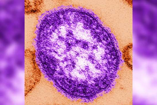 Child dies from measles in UK as health officials warn of outbreak risk