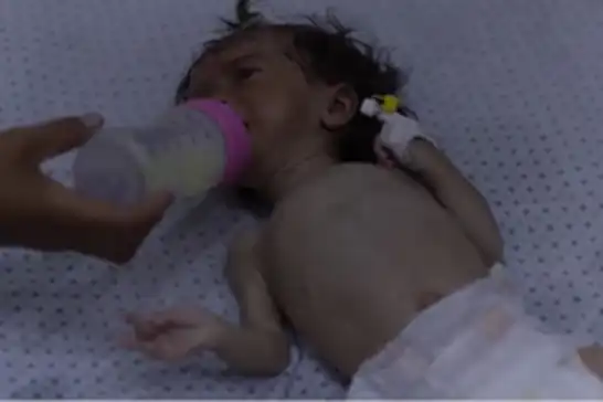 UNICEF: Haziranda Gazze'de 5 bin 800’den fazla çocuk yetersiz beslenme yaşadı