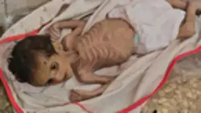 مدير مستشفى الأطفال في مجمع ناصر: أجساد الأطفال تتحلل ببطء تحت وطأة الجوع وسوء التغذية