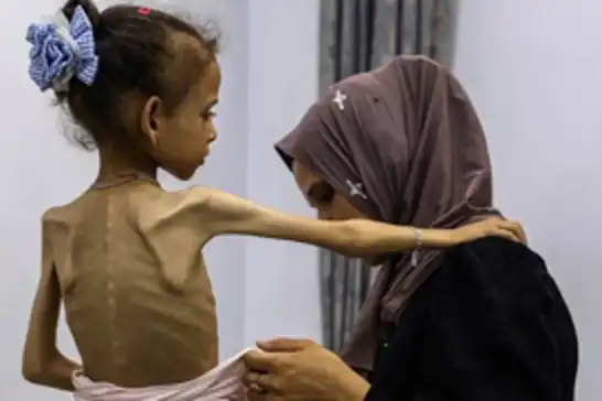 17 ألف طفل في غزة يدخلون مرحلة سوء التغذية الحاد