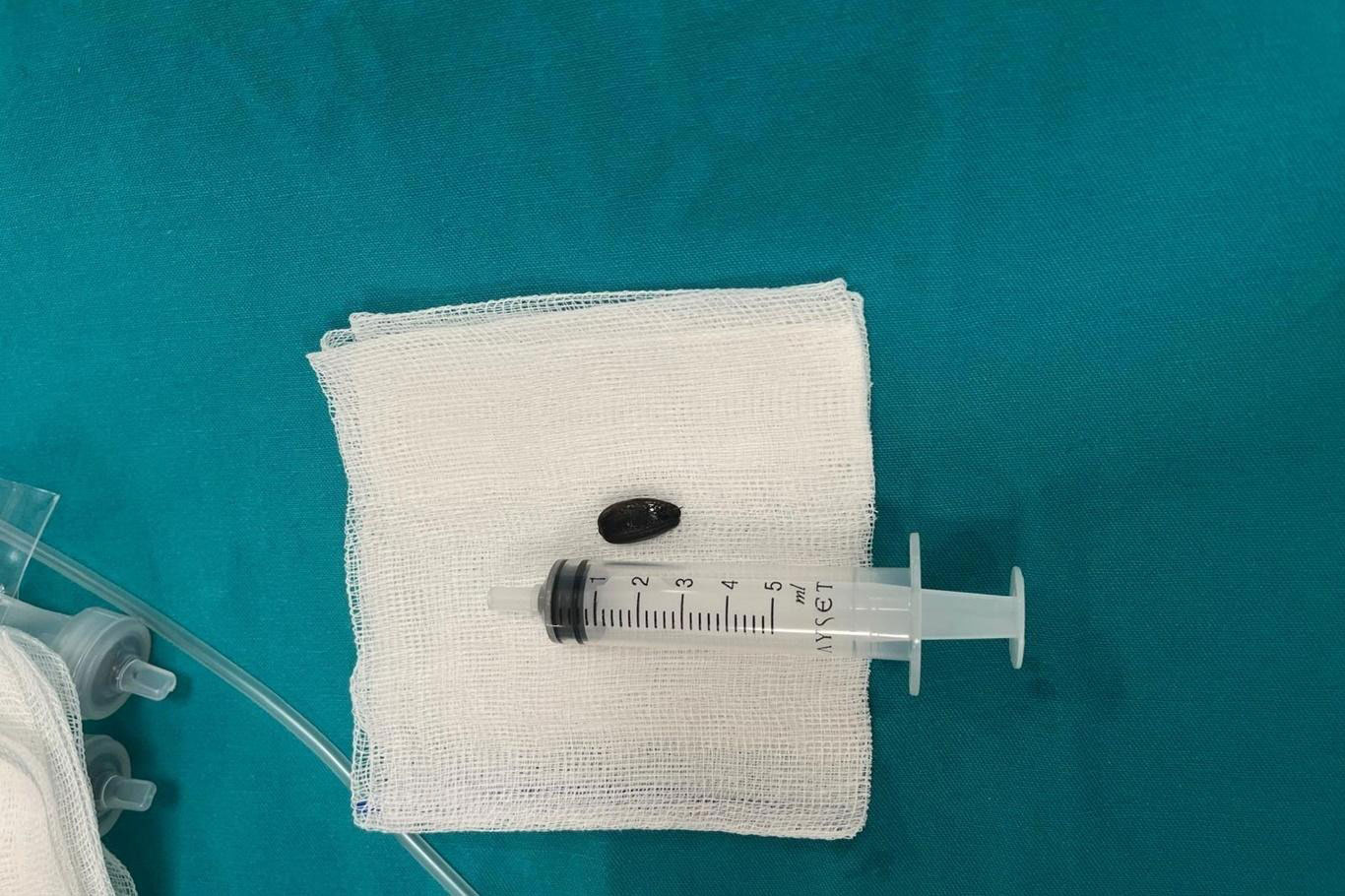 15 aylık bebek Heimlich manevrasıyla hayata tutundu, acil ameliyatla kurtarıldı 15 aylık bebek Heimlich manevrasıyla hayata tutundu, acil ameliyatla kurtarıldı