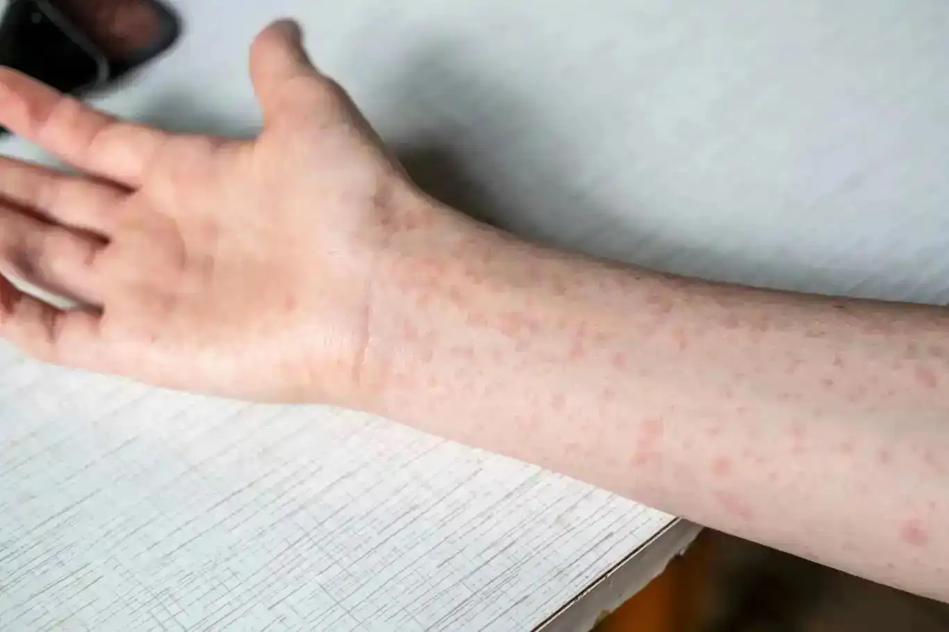 لە ئەندەنۆسیا نەخۆشی سورێژە بڵاو بووە: ١٧ کوژراو