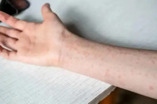 لە ئەندەنۆسیا نەخۆشی سورێژە بڵاو بووە: ١٧ کوژراو