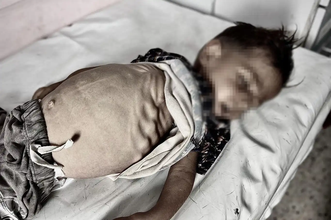 Israel’s blockade continues to starve Palestinian children