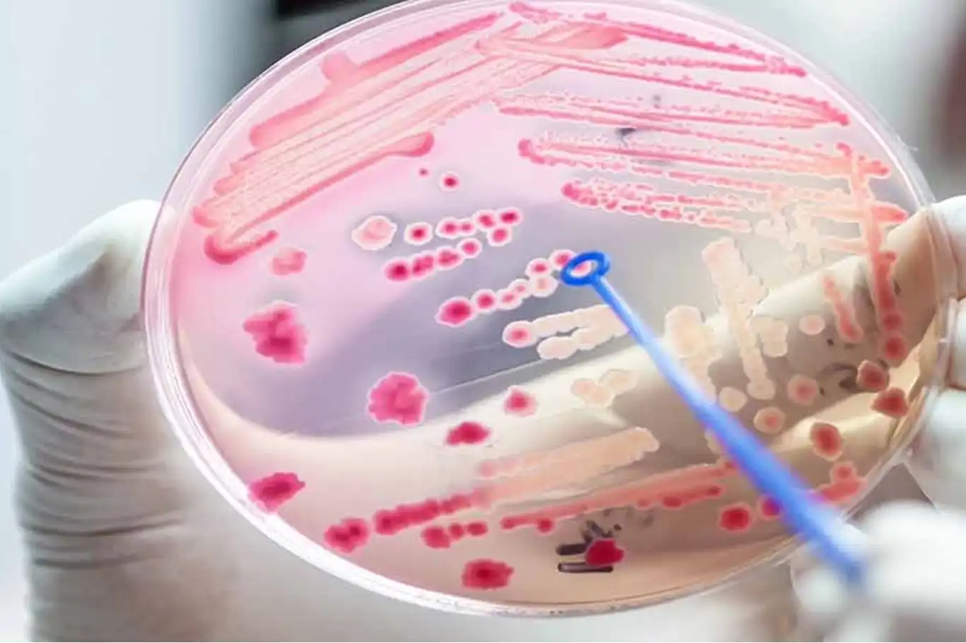 Sepsis her yıl 30 milyondan fazla insanı etkiliyor Sepsis her yıl 30 milyondan fazla insanı etkiliyor