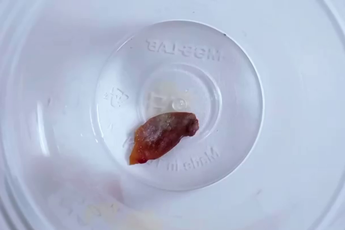 Bir buçuk yıllık öksürüğün sebebi kabak çekirdeği çıktı Bir buçuk yıllık öksürüğün sebebi kabak çekirdeği çıktı