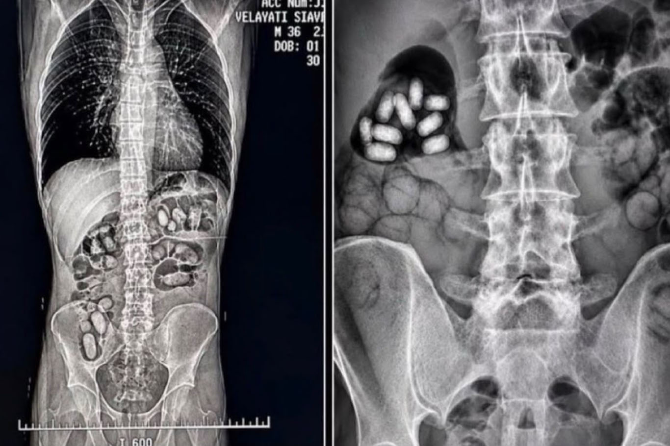 Havalimanında yutulan 60 kapsülde 495 gram metamfetamin ele geçirildi