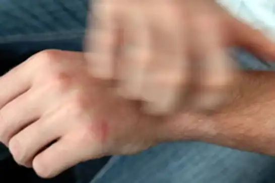 Kaşıntı ve stres birbirini besliyor!
