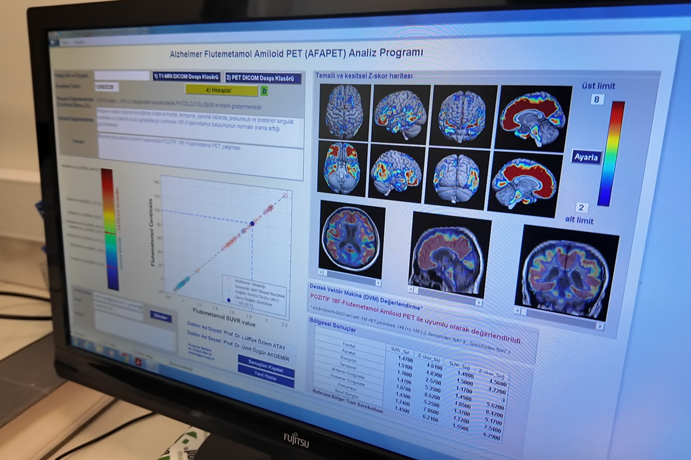 Alzheimer araştırmalarında Türkiye'ye uluslararası ilgi
