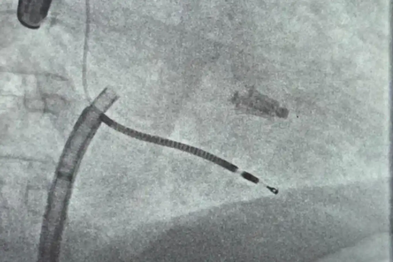 İzmir’de MitraClip yöntemiyle ilk mitral kapak onarımı yapıldı
