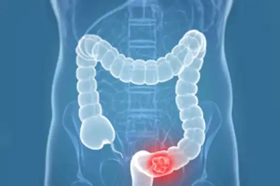 MIT study links high-fat diet to colon cancer spread