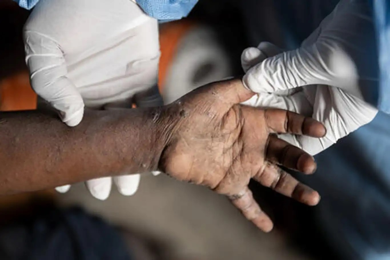 Mpox cases in Ghana surpass 1,000 as outbreak spreads nationwide