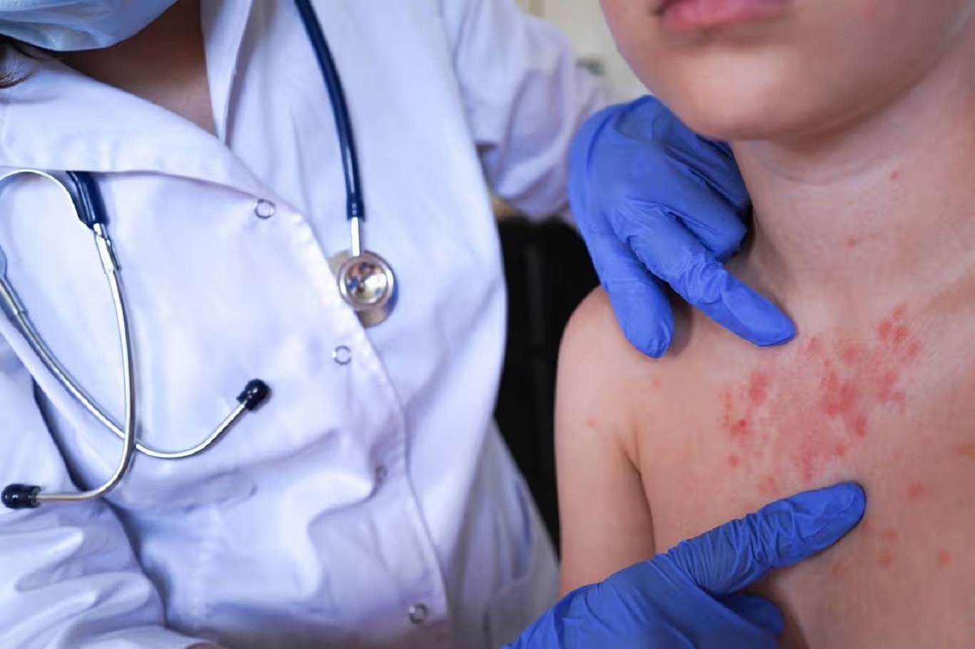 Two children die from measles amid ongoing outbreak across England