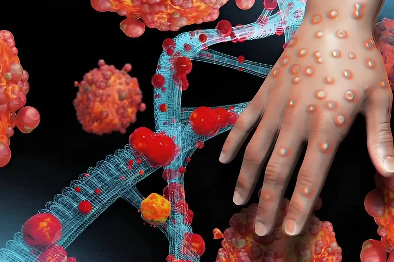 Madagascar's confirmed mpox cases surpass 2,000