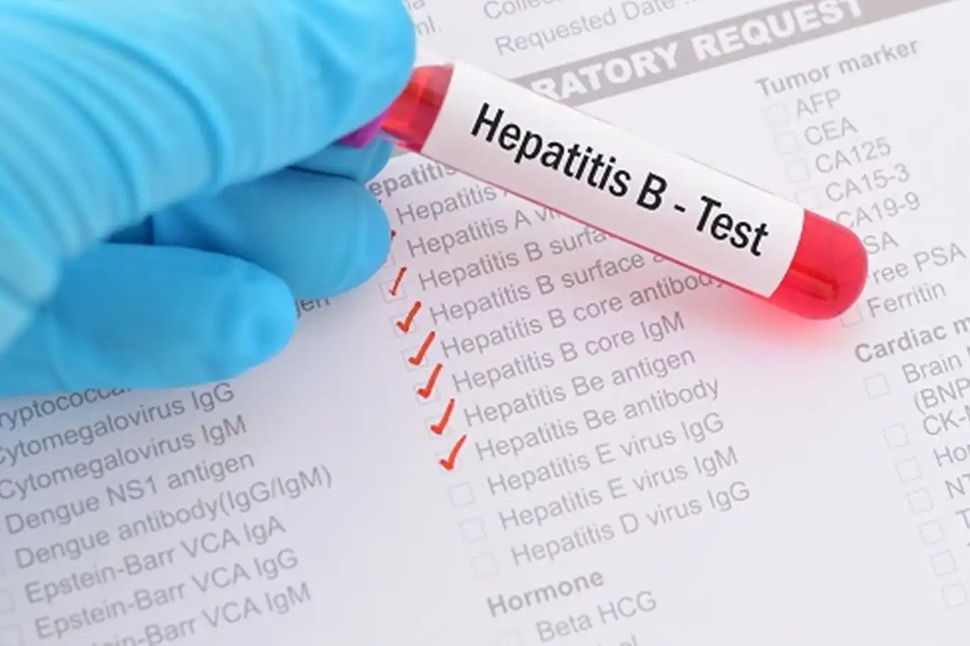 Hepatit B uyarısı: Sessiz ilerleyen hastalık siroza kadar gidebiliyor