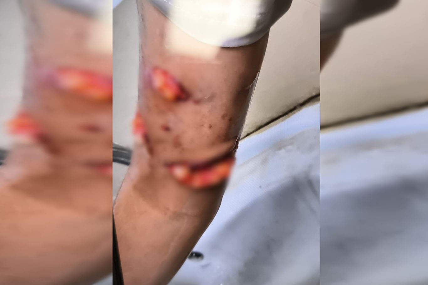 Şanlıurfa'da köpek saldırısına uğrayan Hevin için HÜDA PAR'dan yetkililere çağrı