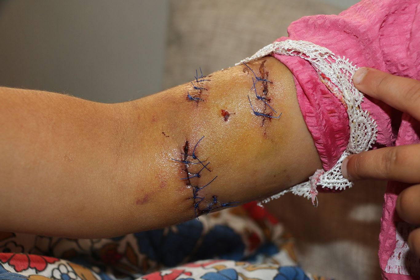 Şanlıurfa'da köpek saldırısına uğrayan Hevin için HÜDA PAR'dan yetkililere çağrı