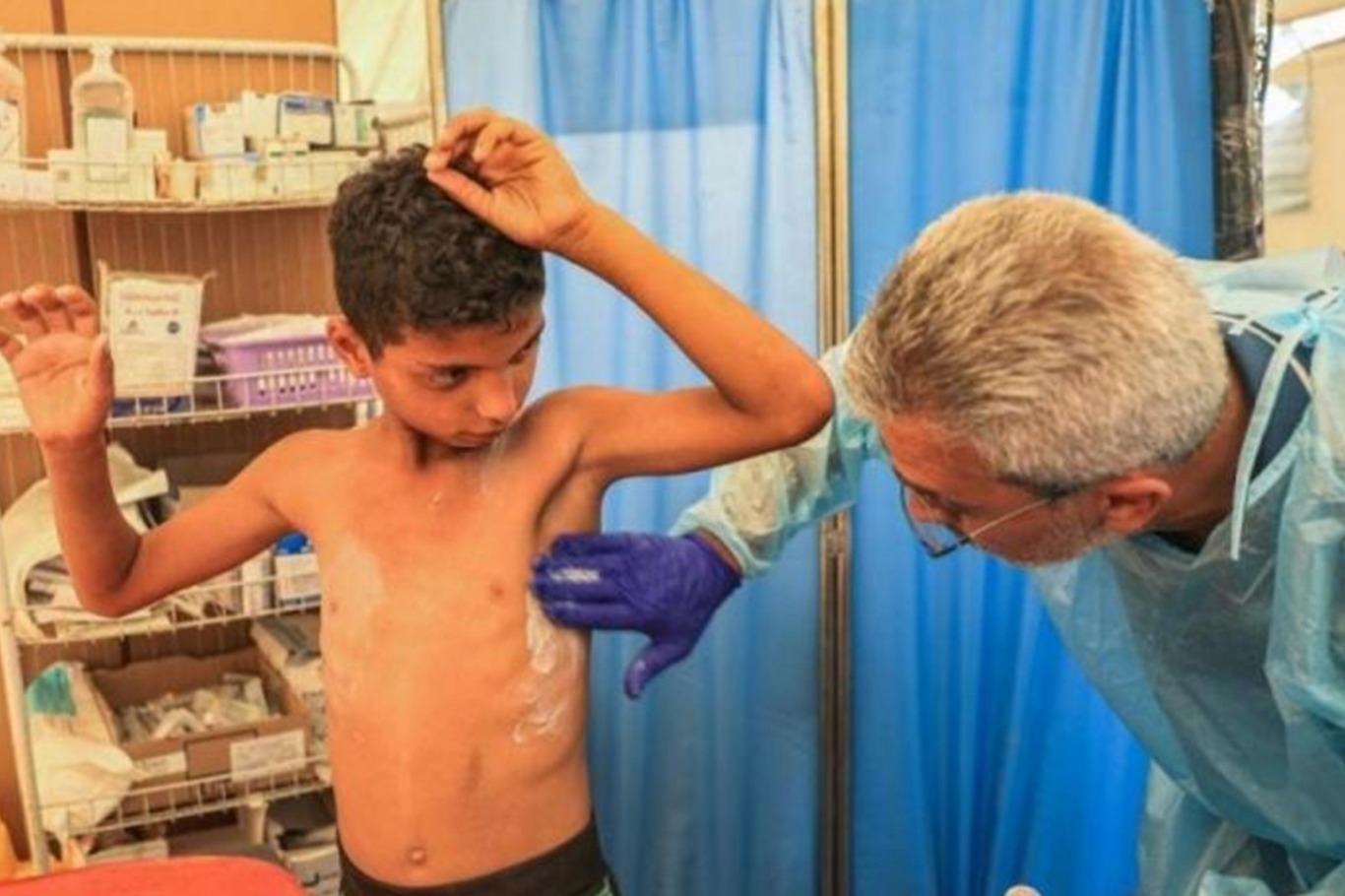 الأمم المتحدة تحذر من تفشي جدري الماء بين النازحين في قطاع غزة