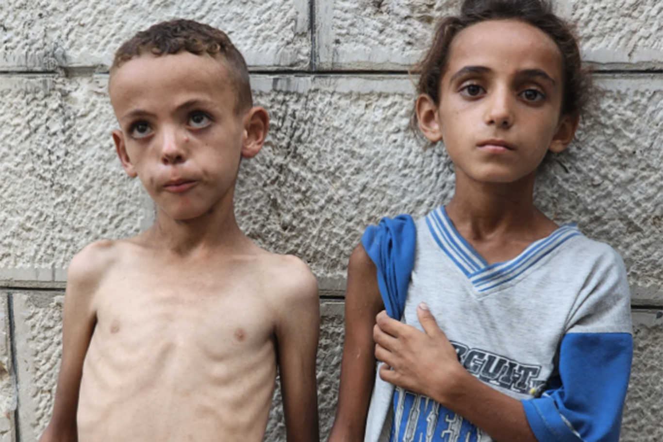 Gaza children face long-term malnutrition damage despite decline in acute hunger