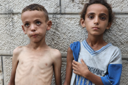 Gaza children face long-term malnutrition damage despite decline in acute hunger