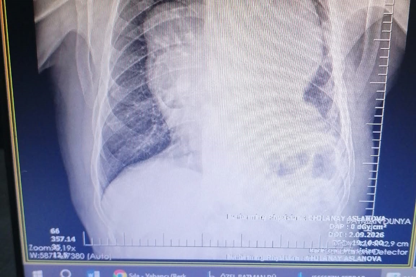 Kalp ve ana damarlara baskı yapan 5 kilogramlık kitle ameliyatla çıkarıldı