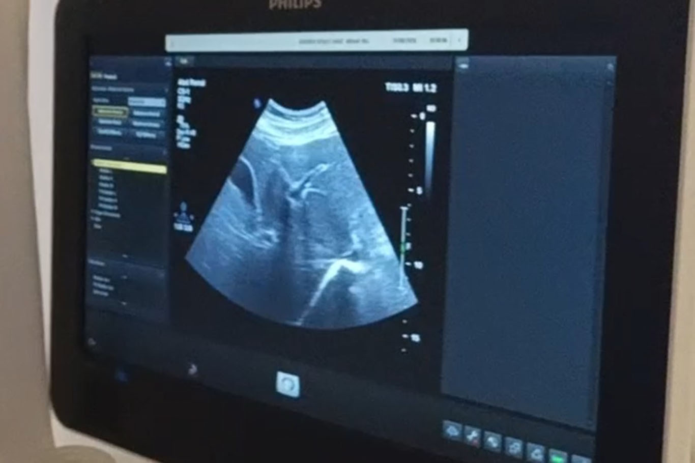 Kronik Hepatit B hastalarına karaciğer biyopsisi hizmeti başladı