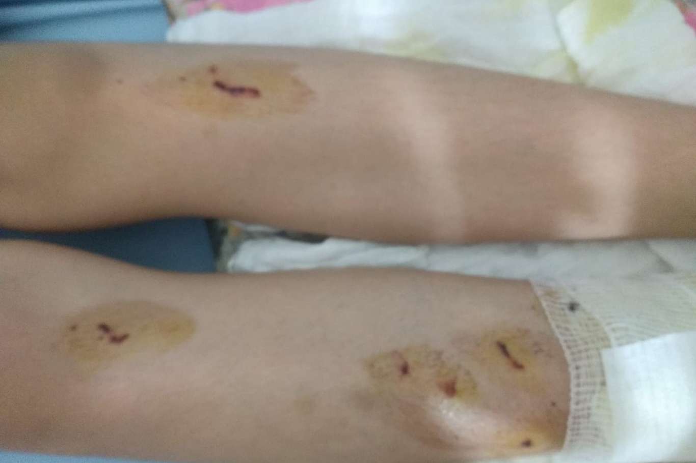 Balkona atılan torpilin patlaması sonucu 12 yaşındaki çocuk yaralandı